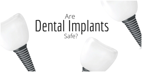 are-dental-implants-safe