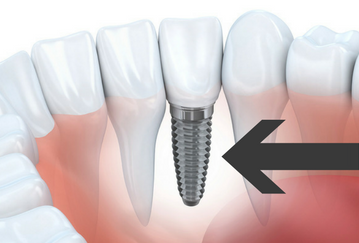 titanium dental implant explained